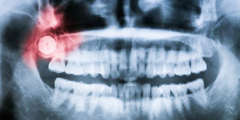 We finally know why we grow wisdom teeth as adults